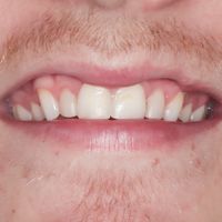 Porcelain Veneers - Smile 3 before